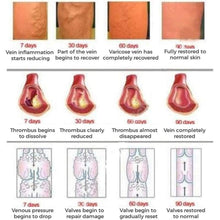 Load image into Gallery viewer, Dragonvein - Varicose &amp; Spider Veins Treatment Cream Cosmetics