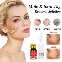 Load image into Gallery viewer, Skin Tag Remover Gesicht Hautpflege Werkzeuge